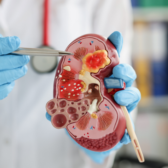 Types of Kidney Stones