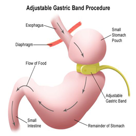 Bariatric Obesity Surgery