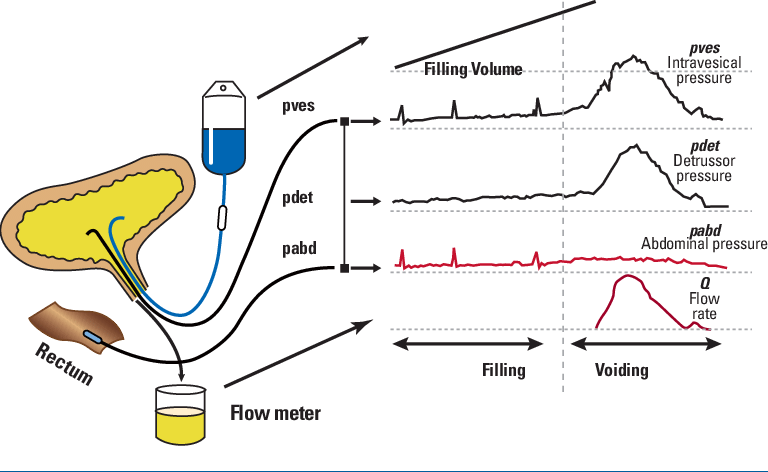 Cystometry Diagnostic Procedure