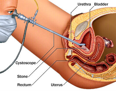 Endoscopic Procedures Cystolitholapaxy