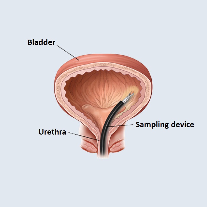 Endoscopy Surgeries for Bladder Tumor